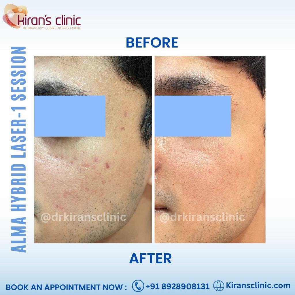 Almahybrid laser_skin rejuvenation in mumbai