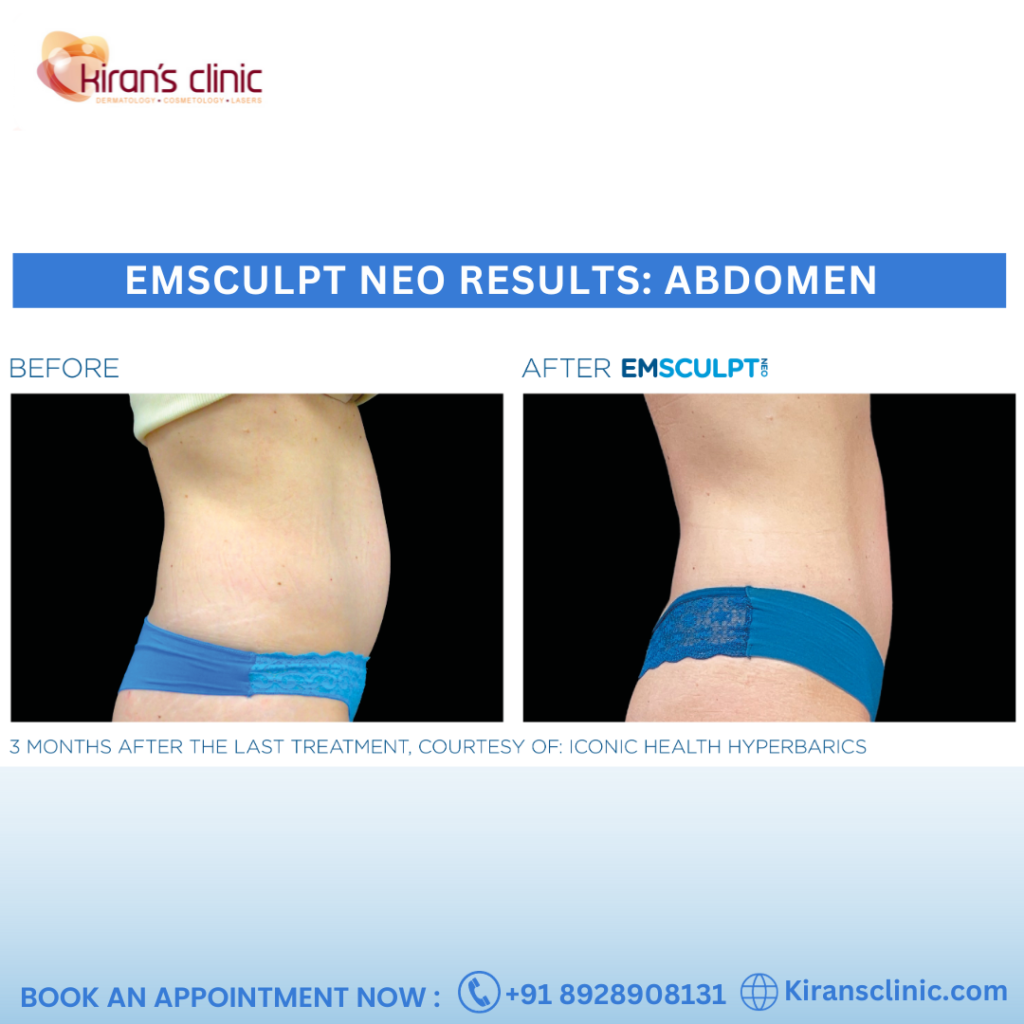 Emsculpt neo result