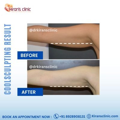 coolsculpting in Mumbai, Andheri